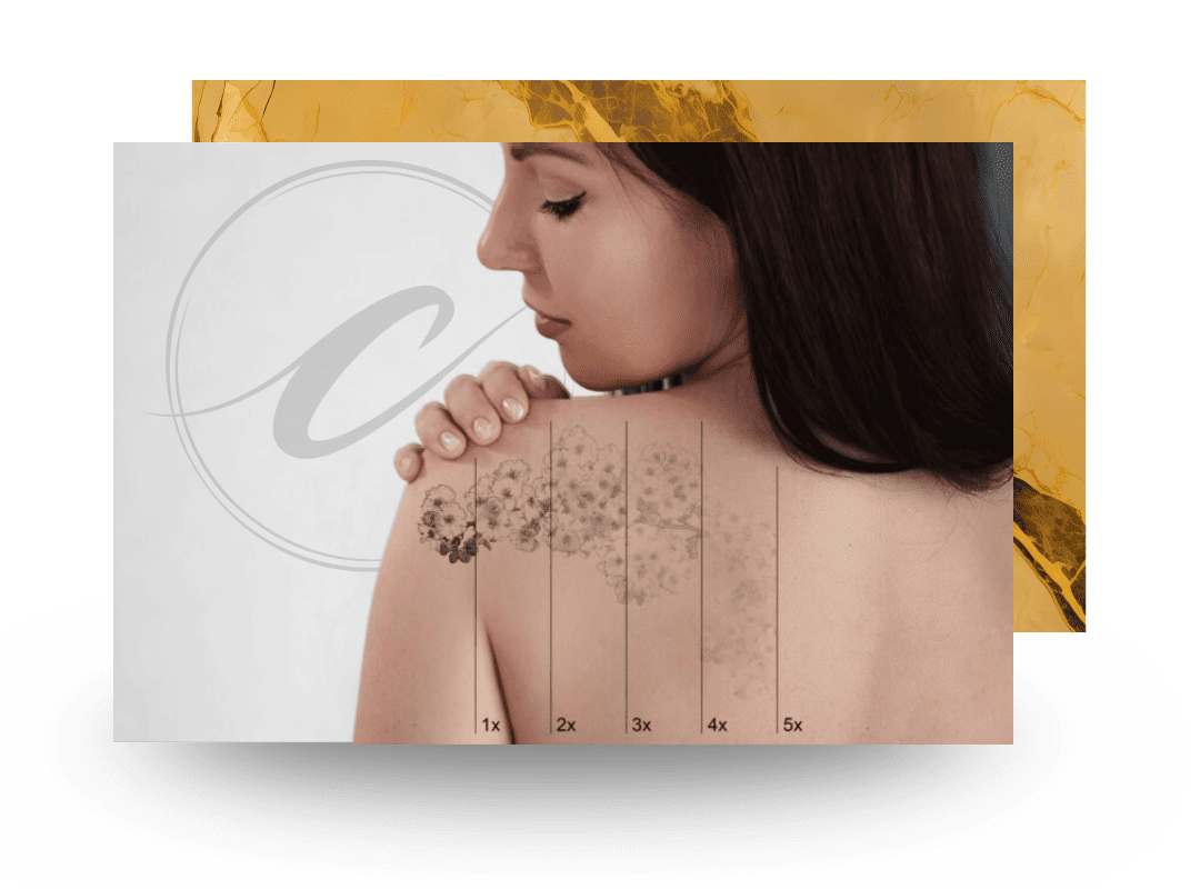 Client receiving advanced laser tattoo removal for clean, clear skin at Cloud Nine Aesthetics.