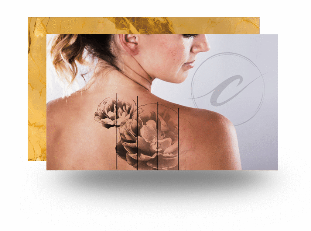 Laser tattoo removal treatment performed at Cloud Nine Aesthetics in Jacksonville IL.