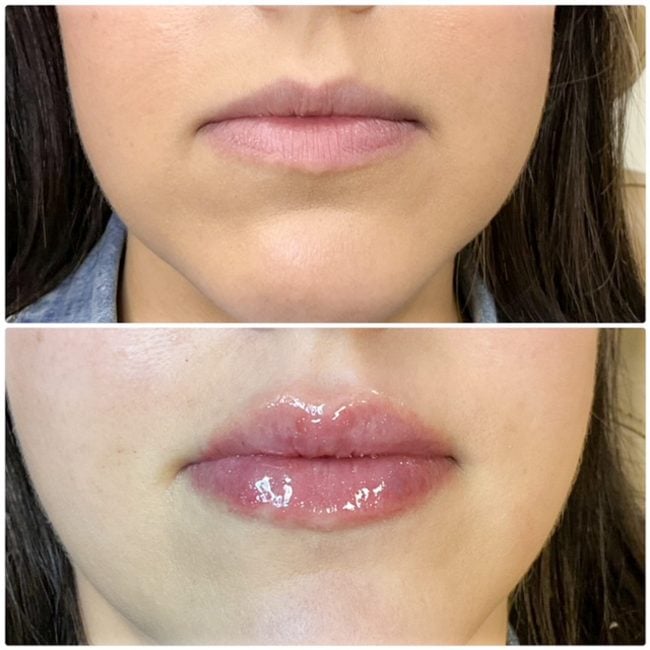 Dermal filler before and after showing natural volume restoration and facial contouring at Cloud Nine Aesthetics Jacksonville IL.
