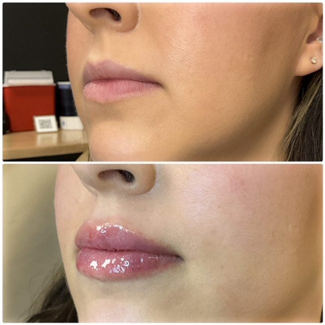 Before and after dermal filler showing natural volume restoration at Cloud Nine Aesthetics in Jacksonville IL.