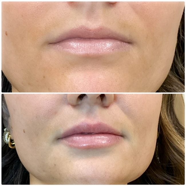 Facial contouring transformation with dermal filler before and after treatment at Cloud Nine Aesthetics Jacksonville IL.