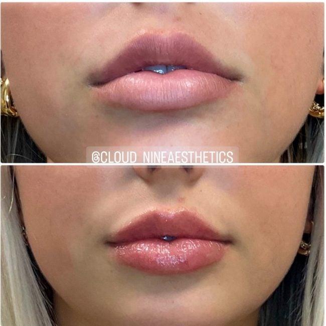 Facial contouring transformation with dermal filler before and after treatment at Cloud Nine Aesthetics Jacksonville IL.