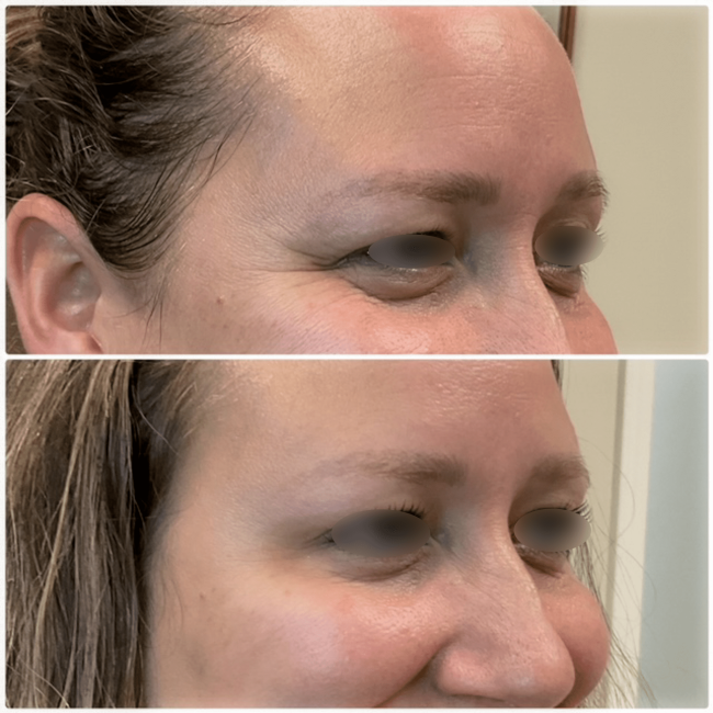 Before and after dermal filler showing natural volume restoration at Cloud Nine Aesthetics in Jacksonville IL.